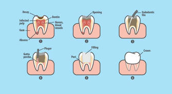 Understanding Root Canal Treatment: When and Why You Need It