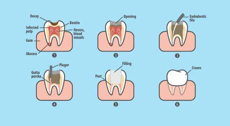 Understanding Root Canal Treatment: When and Why You Need It